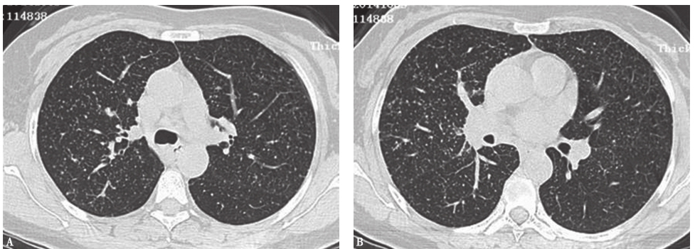 图3肺癌伴肺内转移CT表现