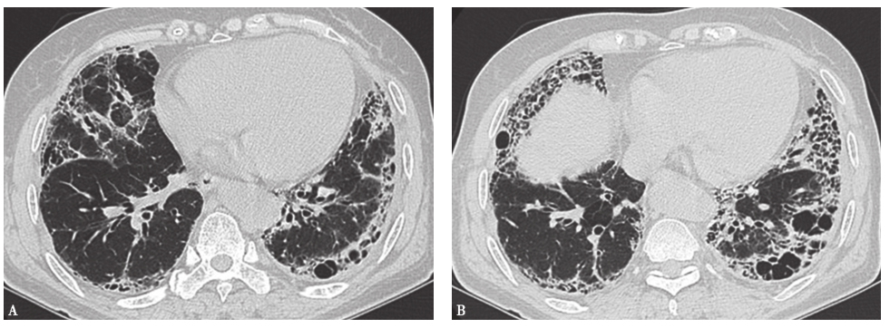 图5特发性肺纤维化胸部CT表现