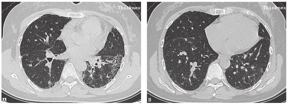 图6非特异性间质性肺炎胸部CT表现