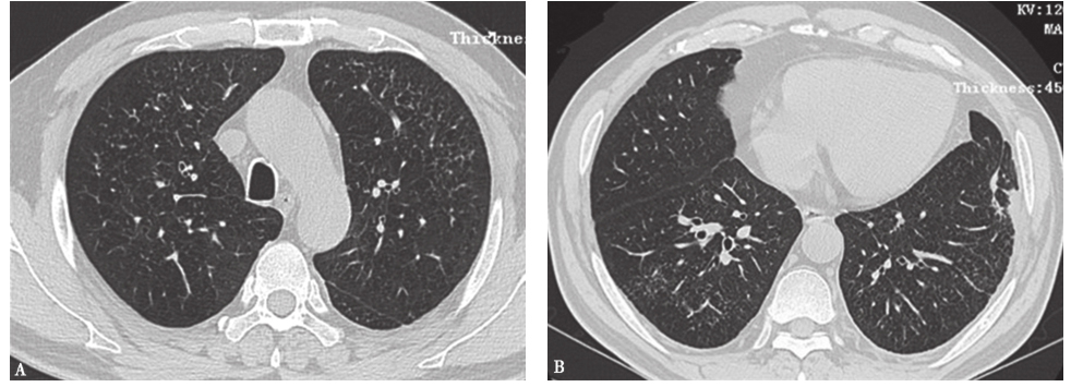 图7RB-ILD胸部CT表现