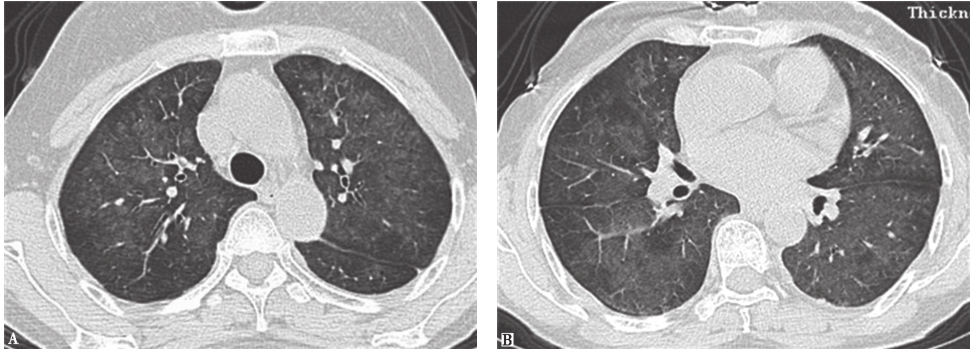 图8急性过敏性肺炎胸部CT表现