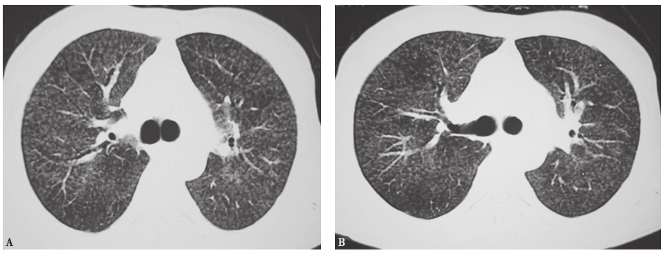 图9亚急性过敏性肺炎胸部CT表现