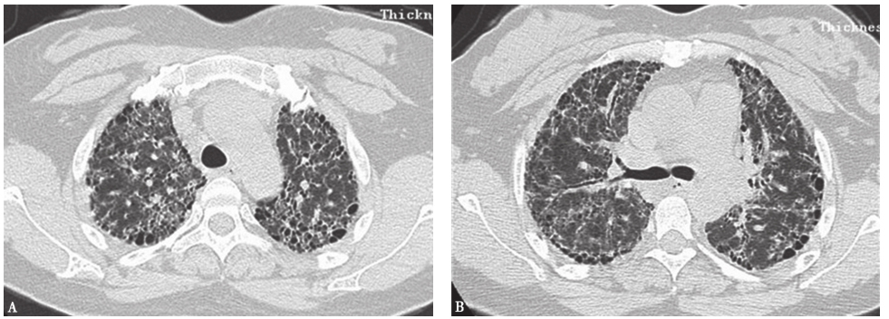 图10慢性过敏性肺炎胸部CT表现