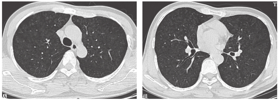 图11尘肺胸部CT表现