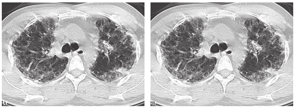 图12巨细胞间质性肺炎胸部影像学表现