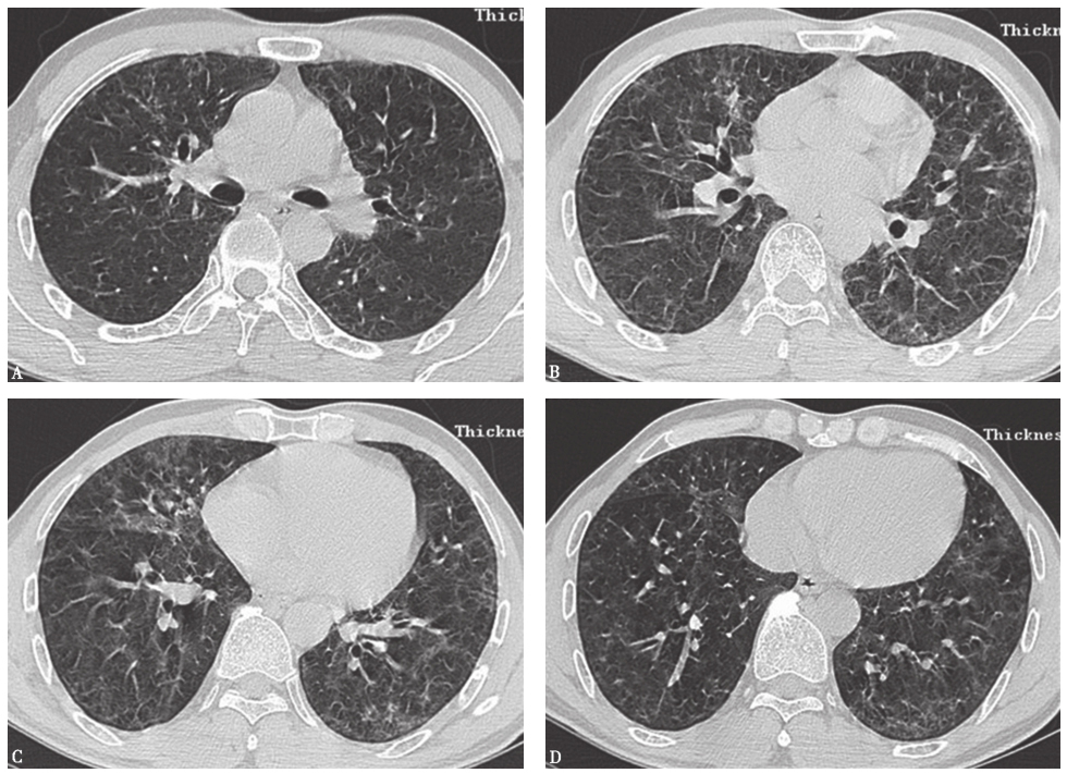 图13入院后胸部HRCT表现