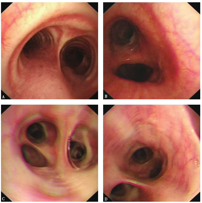 图14支气管镜检查镜下表现