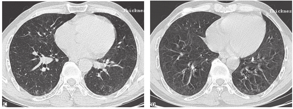 图17泼尼松治疗1个月后胸部HRCT表现-6902304544819200