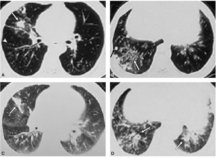 /uploads/image/2025-11-13/165530249图1外院不同时间点胸部CT扫描提示:双肺弥漫性细小结节影(白箭头),斑片影、实变影呈一定的游走性(白箭),并牵拉6902326821636096.jpg 图1外院不同时间点胸部CT扫描提示:双肺弥漫性细小结节影(白箭头),斑片影、实变影呈一定的游走性(白箭),并牵拉6902326821636096