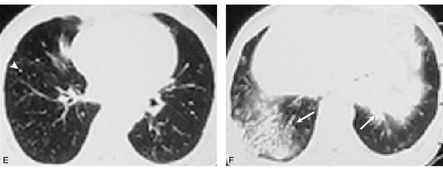 /uploads/image/2025-11-13/165624710图1外院不同时间点胸部CT扫描提示:双肺弥漫性细小结节影(白箭头),斑片影、实变影呈一定的游走性(白箭),并牵拉6902327926949888.jpg 图1外院不同时间点胸部CT扫描提示:双肺弥漫性细小结节影(白箭头),斑片影、实变影呈一定的游走性(白箭),并牵拉6902327926949888