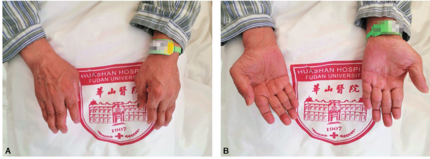 /uploads/image/2025-11-13/170325366图2双手指间关节呈梭形肿胀及天鹅颈样畸形.jpg 图2双手指间关节呈梭形肿胀及天鹅颈样畸形