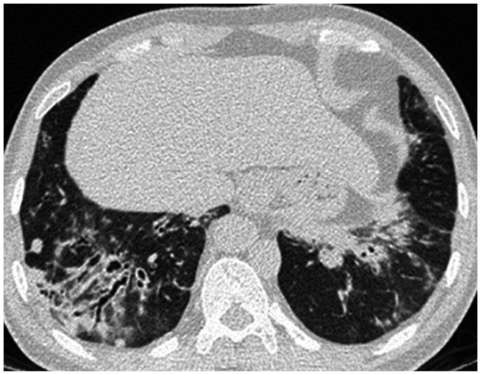 /uploads/image/2025-11-13/171205412图3胸部增强CT示两肺下叶多发结节影、条索影、斑片影,并牵拉性支气管扩张.jpg 图3胸部增强CT示两肺下叶多发结节影、条索影、斑片影,并牵拉性支气管扩张