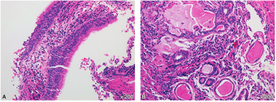 /uploads/image/2025-11-13/171315640图4支气管镜活检病理(×200):(右中叶支气管)黏膜慢性炎症伴大量嗜酸性粒细胞浸润(A),黏液腺增生、高分泌及黏液潴留(B).jpg 图4支气管镜活检病理(×200):(右中叶支气管)黏膜慢性炎症伴大量嗜酸性粒细胞浸润(A),黏液腺增生、高分泌及黏液潴留(B)