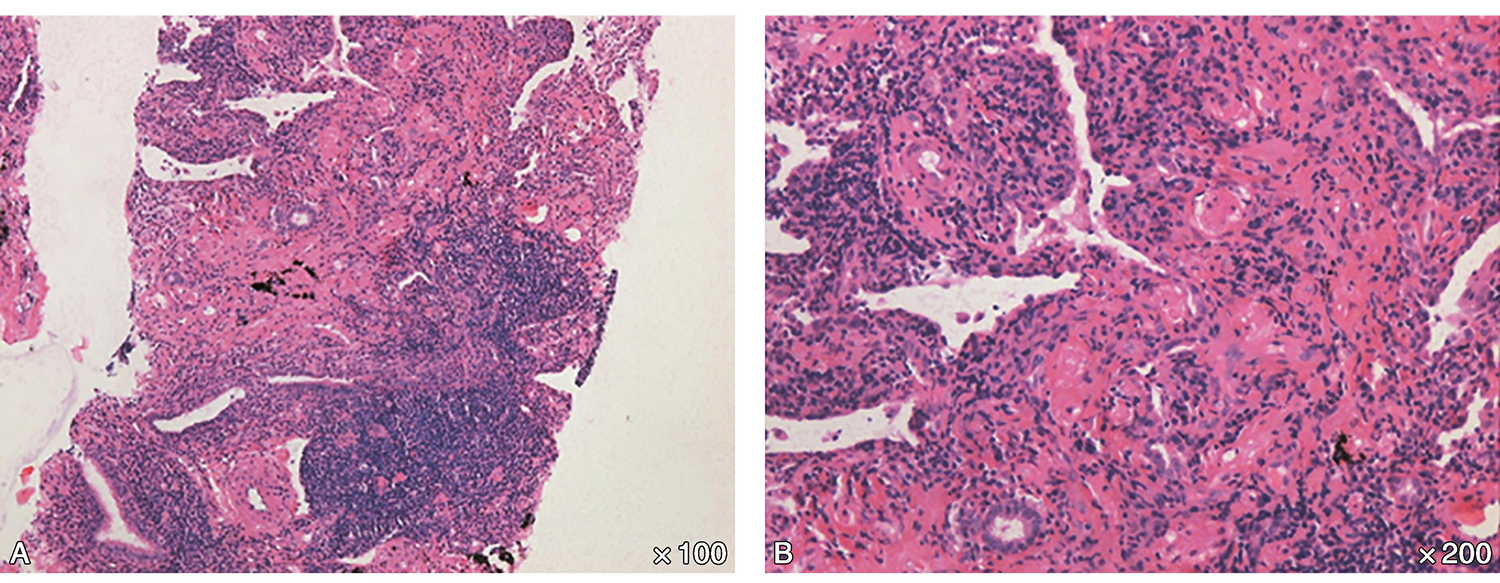/uploads/image/2025-11-13/171421081图5CT引导下经皮肺穿刺活检病理(A:×100,B:×200):(右肺下叶)慢性炎症,伴纤维组织增生,炎细胞以淋巴细胞为主,见少量嗜酸性粒细胞.jpg 图5CT引导下经皮肺穿刺活检病理(A:×100,B:×200):(右肺下叶)慢性炎症,伴纤维组织增生,炎细胞以淋巴细胞为主,见少量嗜酸性粒细胞