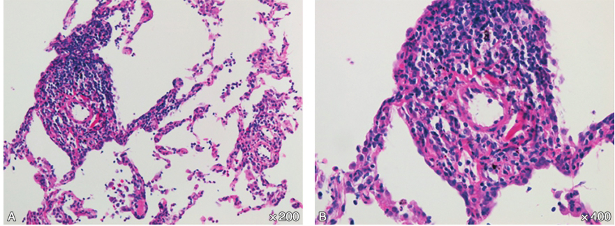 /uploads/image/2025-11-13/171620882图6CT引导下经皮肺穿刺活检病理(A:×200,B:×400):(右下肺结节)间质内急、慢性炎细胞浸润及少量嗜酸性粒细胞.jpg 图6CT引导下经皮肺穿刺活检病理(A:×200,B:×400):(右下肺结节)间质内急、慢性炎细胞浸润及少量嗜酸性粒细胞