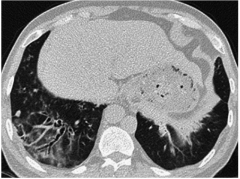 /uploads/image/2025-11-13/171909368图7胸部CT平扫示双肺下叶基底段病灶较前明显吸收.jpg 图7胸部CT平扫示双肺下叶基底段病灶较前明显吸收
