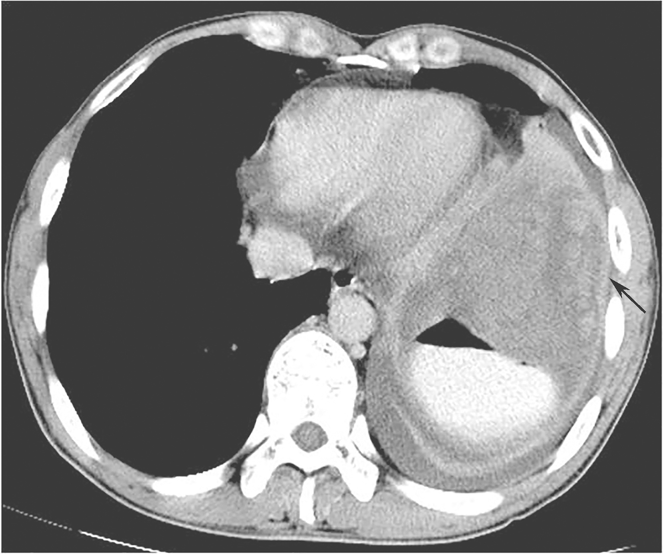 /uploads/image/2025-11-17/142500011图1首诊全腹增强CT示胃底大弯侧来源GIST.jpg 图1首诊全腹增强CT示胃底大弯侧来源GIST