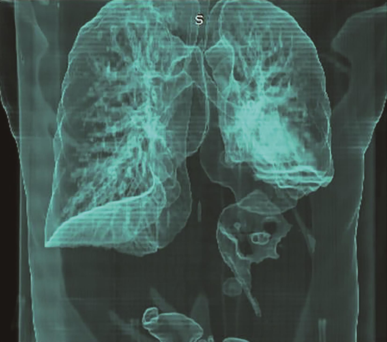 /uploads/image/2025-11-17/142545101图2首诊CT三维重建示左侧膈肌侵犯可能性大.jpg 图2首诊CT三维重建示左侧膈肌侵犯可能性大