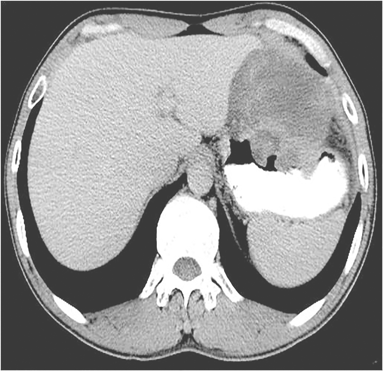 /uploads/image/2025-11-17/142902265图3术前治疗8个月后全腹增强CT.jpg 图3术前治疗8个月后全腹增强CT