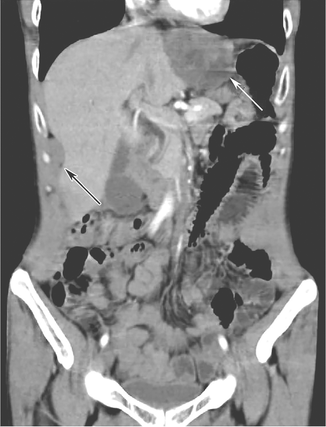 /uploads/image/2025-11-17/142955377图4伊马替尼辅助治疗30个月后全腹增强CT(冠状位).jpg 图4伊马替尼辅助治疗30个月后全腹增强CT(冠状位)