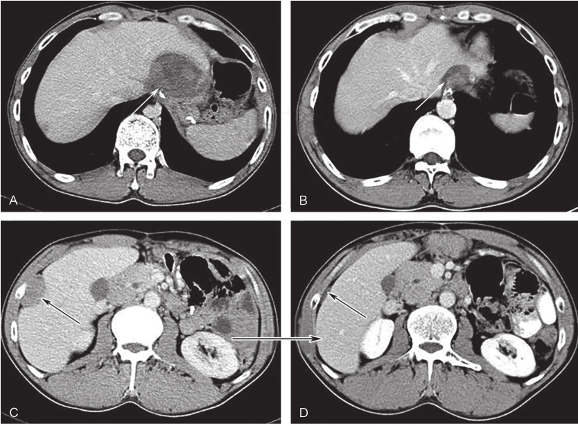 /uploads/image/2025-11-17/143144343图5舒尼替尼治疗9个月后增强CT表现.jpg 图5舒尼替尼治疗9个月后增强CT表现
