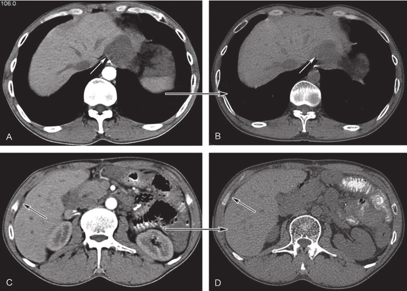 /uploads/image/2025-11-17/143348305图6伊马替尼联合舒尼替尼治疗6个月后CT增强表现.jpg 图6伊马替尼联合舒尼替尼治疗6个月后CT增强表现