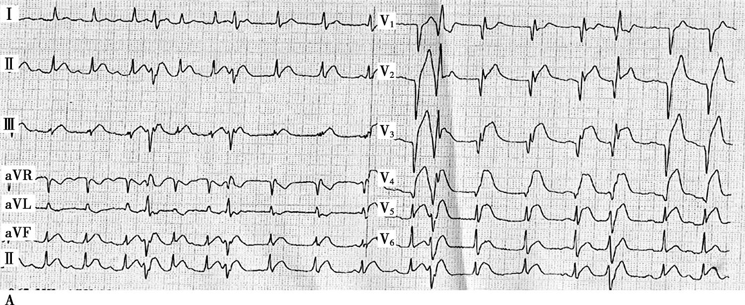 图1当地心电图及急诊PCI结果-7646140283799552