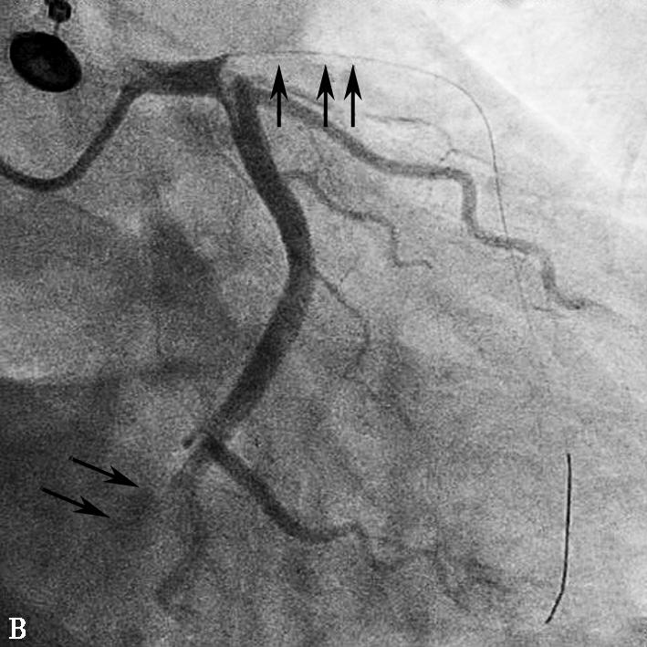 图1当地心电图及急诊PCI结果-7646136054925312