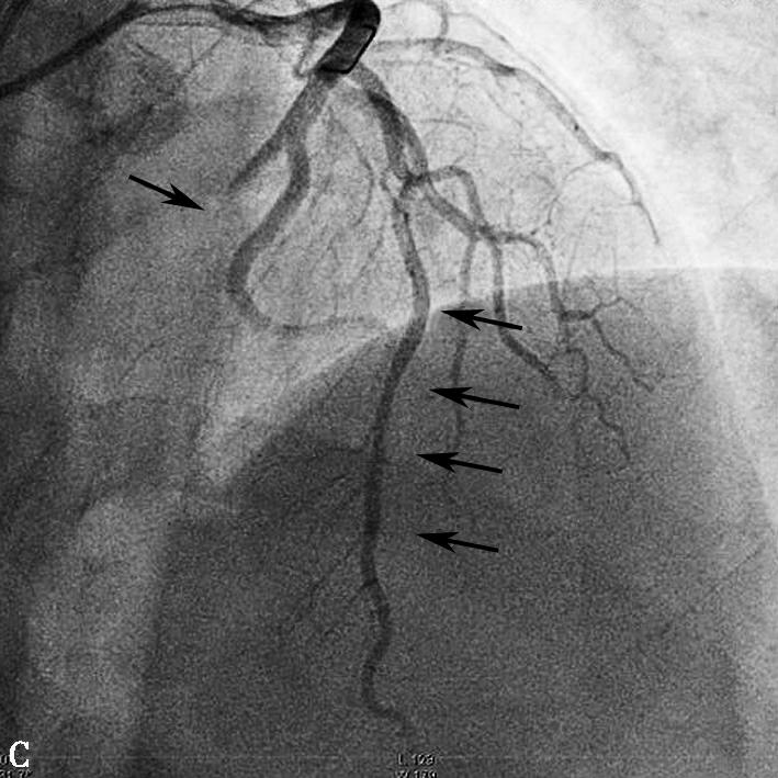 图1当地心电图及急诊PCI结果-7646136286758912
