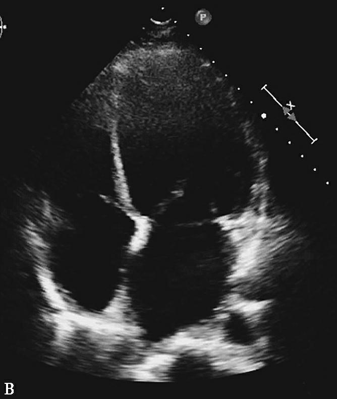 图2抗凝前后超声心动图对比-7646131031148544