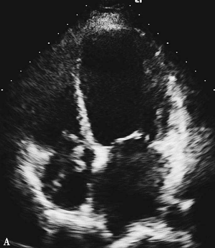 图2抗凝前后超声心动图对比-7646133461207040