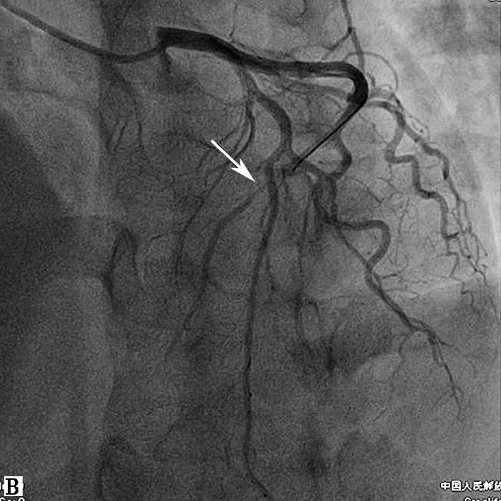 图3冠脉造影结果-7646129612965888