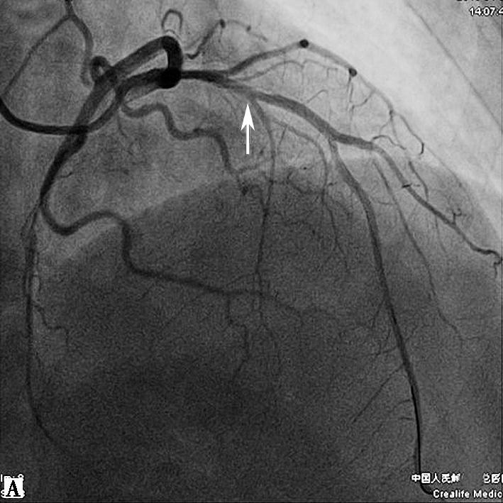 图3冠脉造影结果-7646135897458688