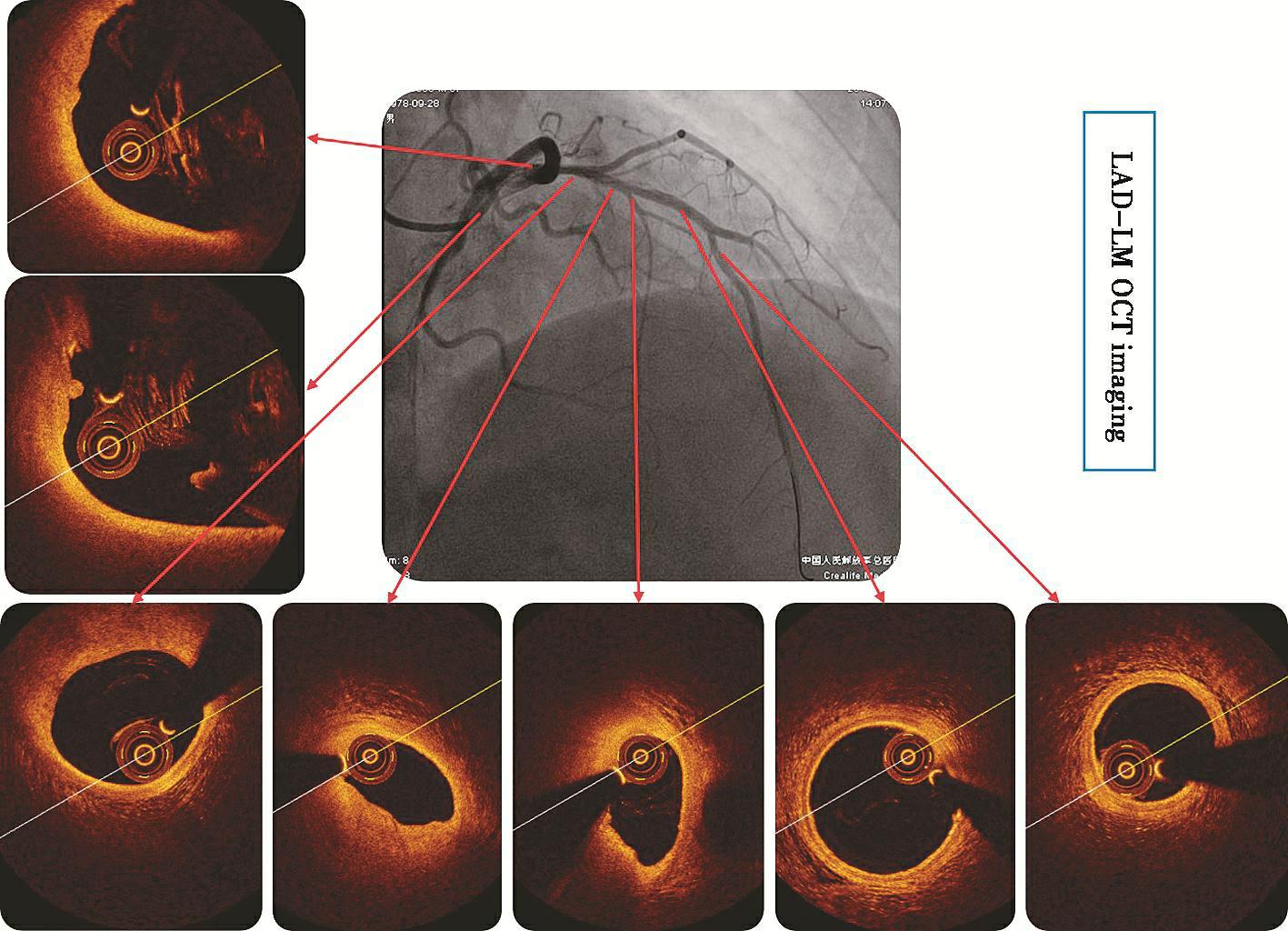 图4前降支OCT影像