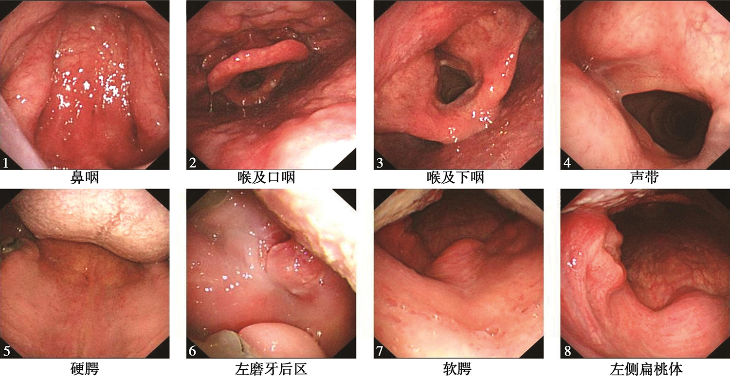 图2电子鼻咽喉镜见左侧磨牙后区及左侧软腭和腭舌弓可见溃疡型肿物