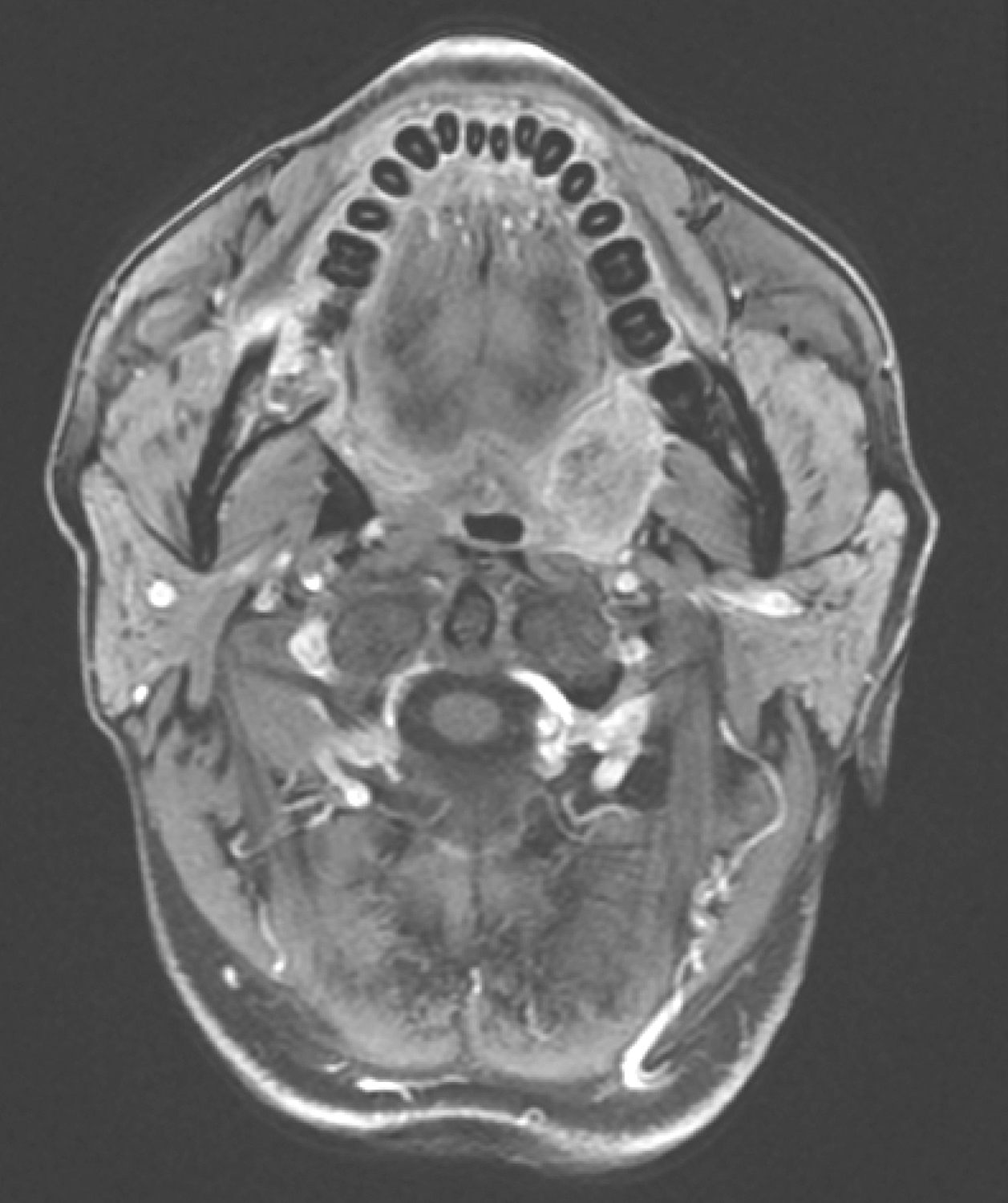 图4口腔MRI示口咽左侧壁肿物