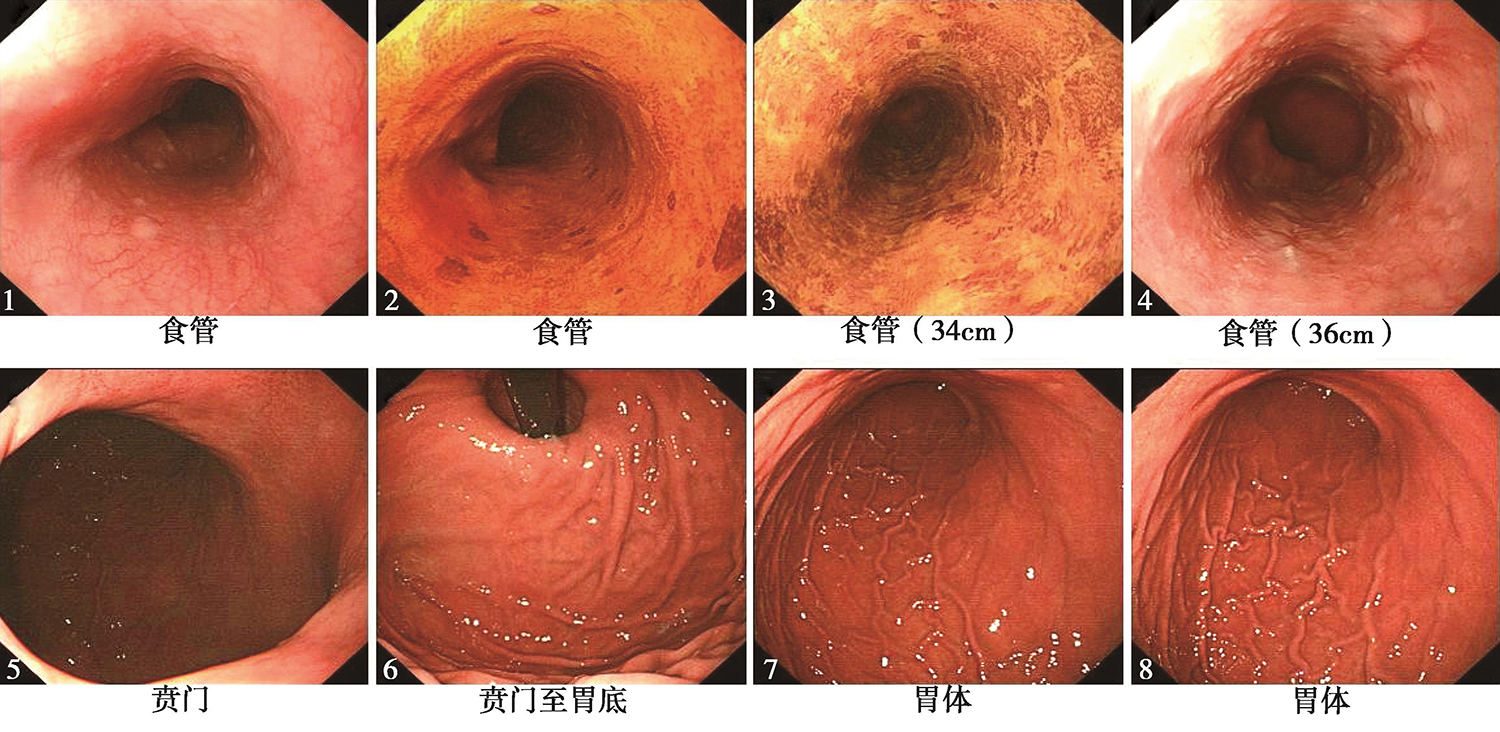 图5电子胃镜见黏膜粗糙且碘染色后可见散在阳性灶；食管至交界线可见条形糜烂灶