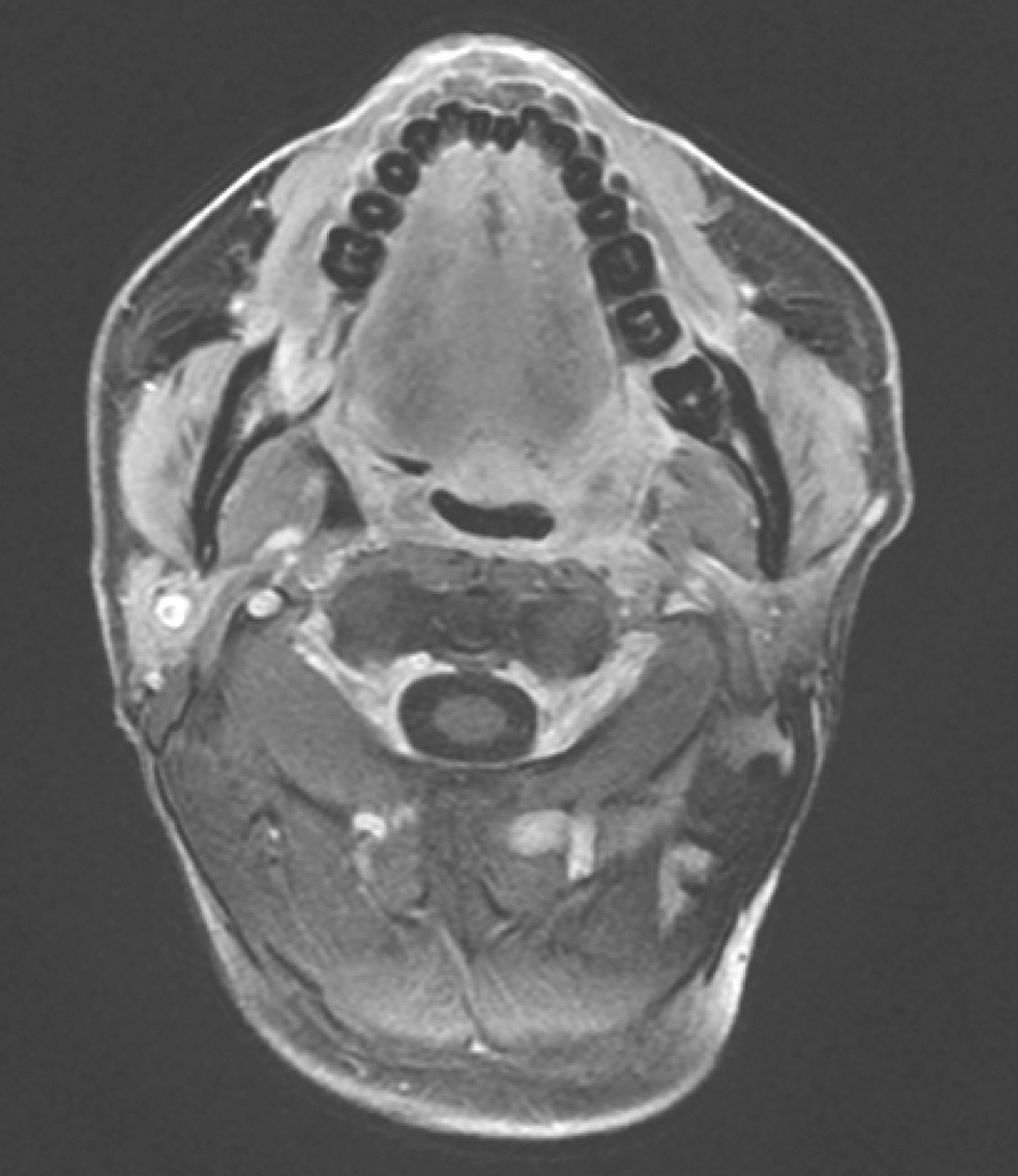 图6复查口腔MRI示口咽左侧壁肿物较前缩小