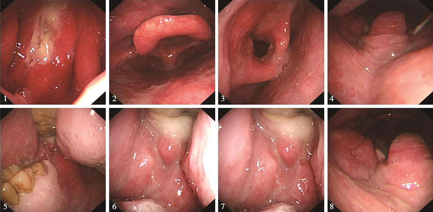 图7电子内镜见口咽左侧壁肿物较前缩小