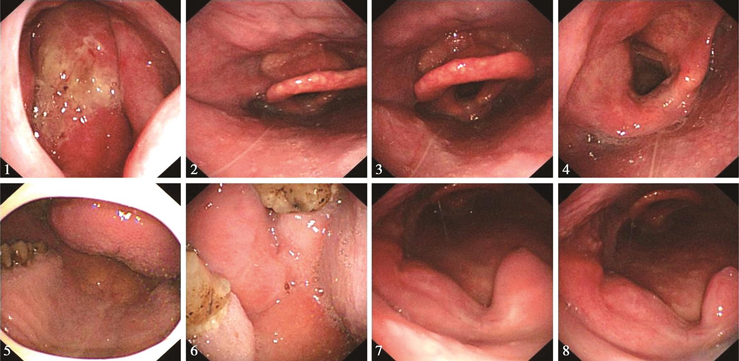 图8电子内镜见左侧扁桃体处肿物似消退