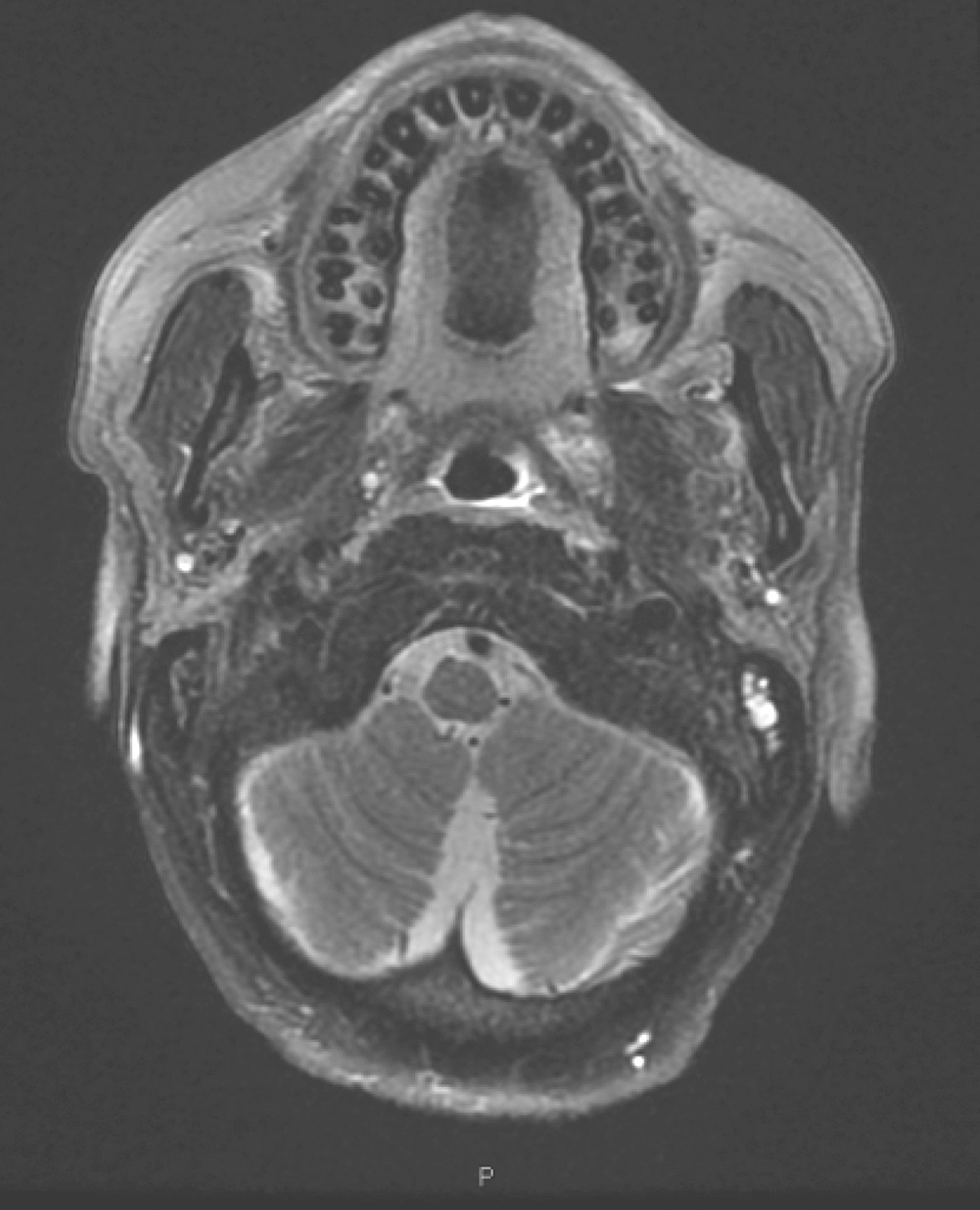 图9口腔MRI示口咽左侧壁肿物较前缩小
