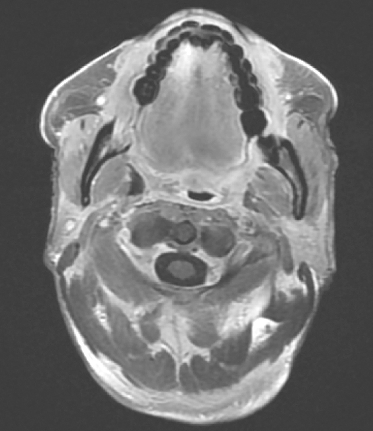 图10口腔MRI示口咽左侧壁肿物现已显示不清，局部仅见口咽壁略增厚