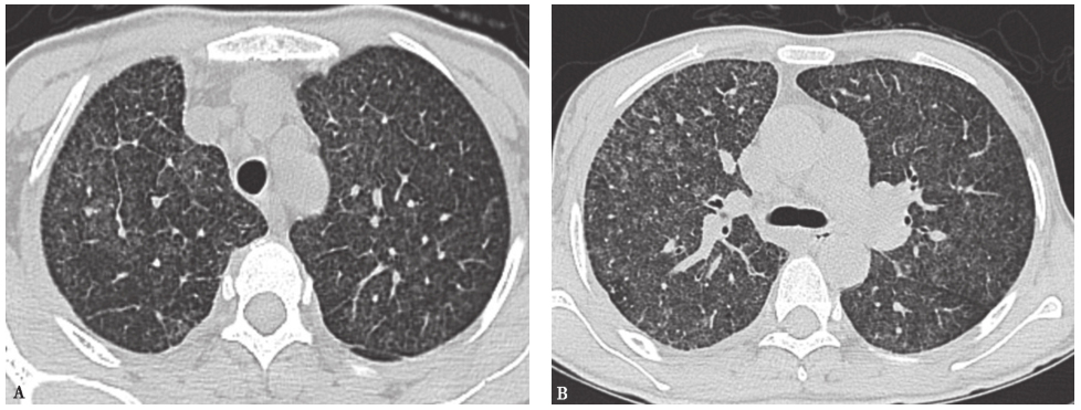 图3粟粒性肺结核胸部CT表现