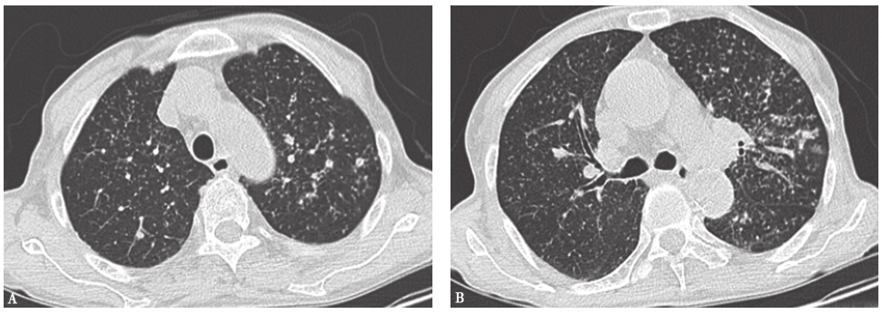 图4肺结核胸部CT表现