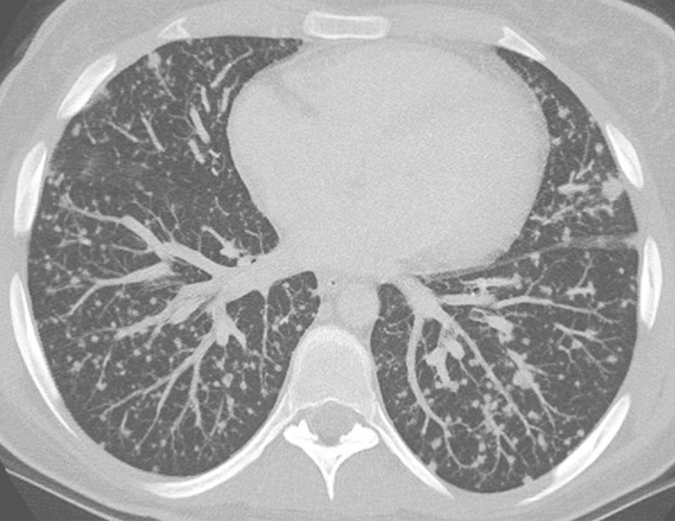 图5念珠菌肺炎胸部CT表现