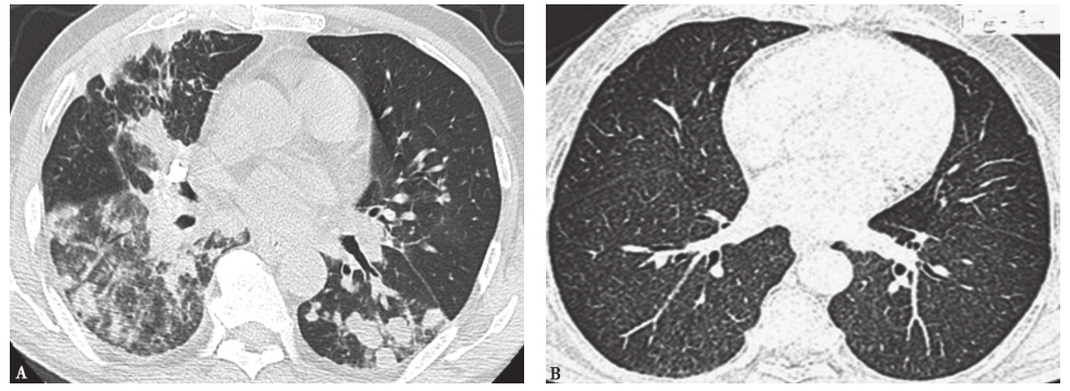 图6隐球菌肺炎胸部CT表现