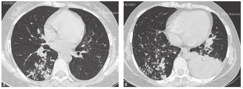 图7肺曲霉菌病胸部影像学表现