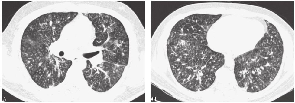 图10肺淋巴管癌病胸部影像学表现