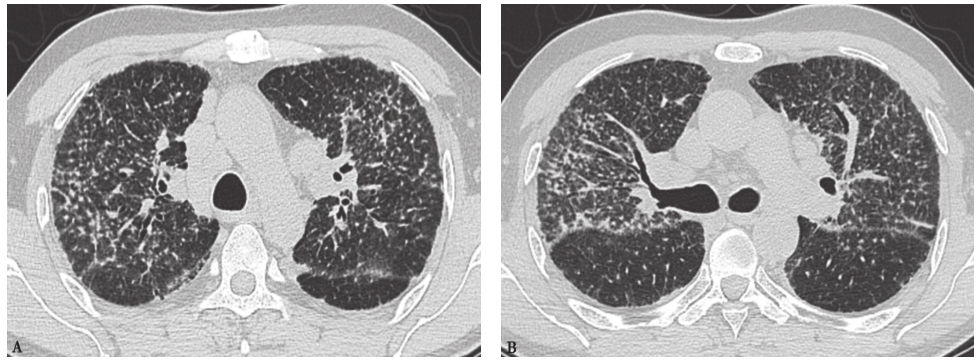图11结节病胸部CT表现