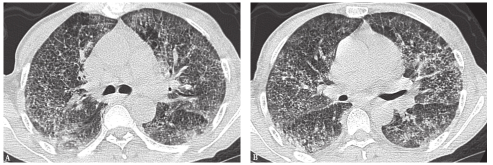 图12急性矽肺胸部影像学表现